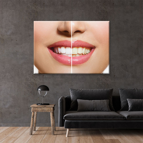 dental-office-wall-decor-1172-02 Diş Beyazlatma Öncesi ve Sonrası Temalı Kanvas Duvar Tablosu – 1172