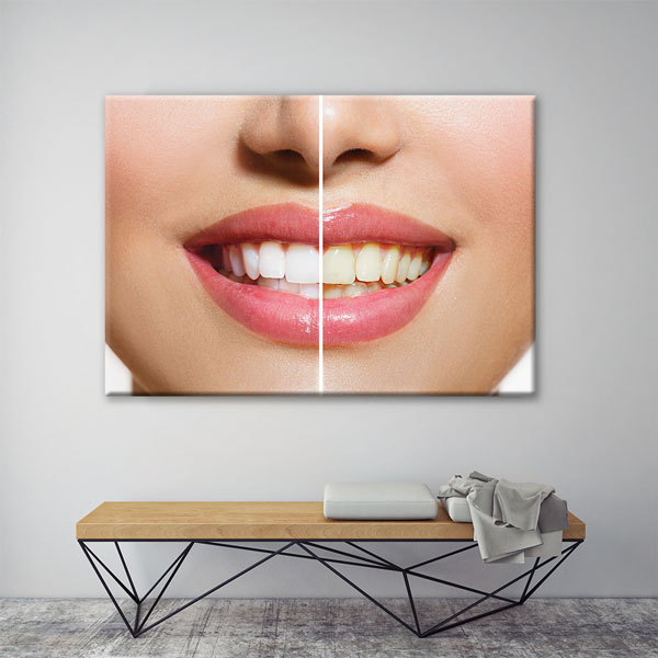 dental-office-wall-decor-1172-03 Diş Beyazlatma Öncesi ve Sonrası Temalı Kanvas Duvar Tablosu – 1172
