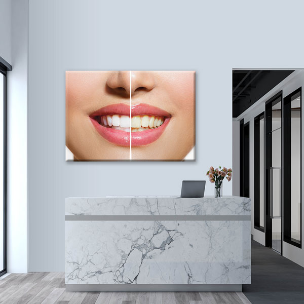 dental-office-wall-decor-1172-04 Diş Beyazlatma Öncesi ve Sonrası Temalı Kanvas Duvar Tablosu – 1172