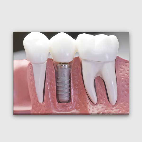 Diş İmplantı Modeli Temalı Kanvas Duvar Tablosu – 1858