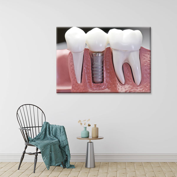 Diş İmplantı Modeli Temalı Kanvas Duvar Tablosu – 1858