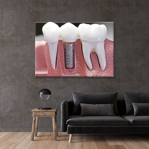 Diş İmplantı Modeli Temalı Kanvas Duvar Tablosu – 1858