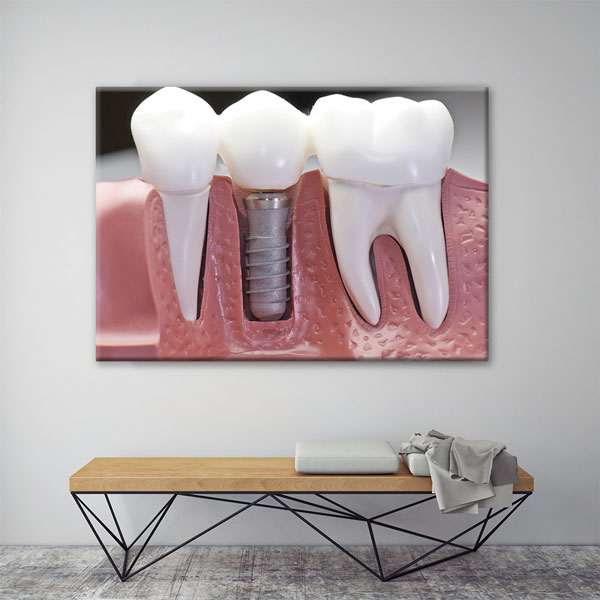 Diş İmplantı Modeli Temalı Kanvas Duvar Tablosu – 1858