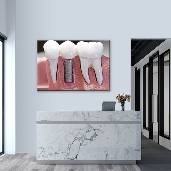 Diş İmplantı Modeli Temalı Kanvas Duvar Tablosu – 1858