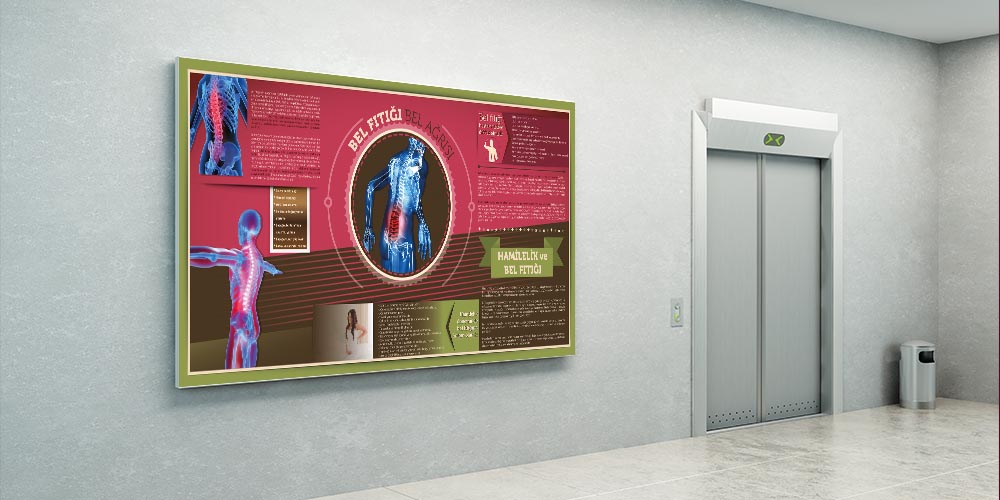 Bel Fıtığı Bilgilendirme Büyük Ebat Poster  1228