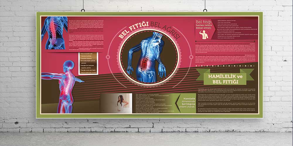 Bel Fıtığı Bilgilendirme Büyük Ebat Poster  1228