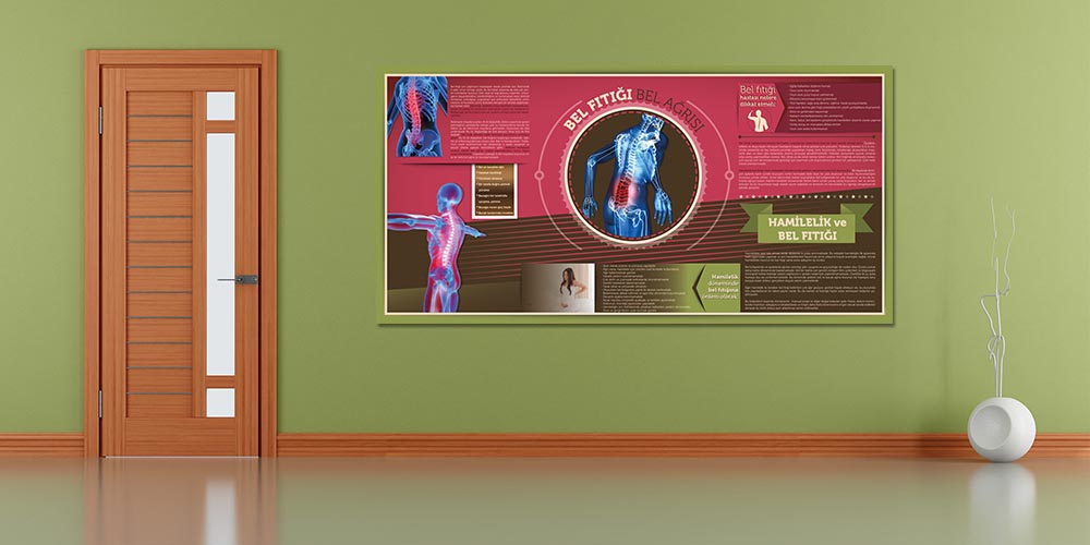 Bel Fıtığı Bilgilendirme Büyük Ebat Poster  1228
