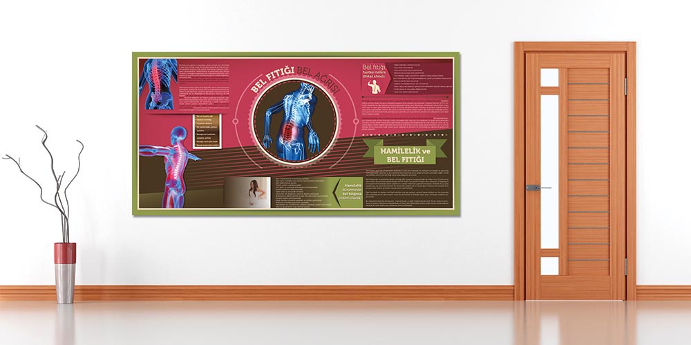 Bel Fıtığı Bilgilendirme Büyük Ebat Poster  1228