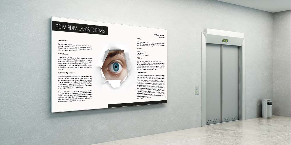 Adım Adım Lazer Tedavisi Bilgilendirme Panosu 1514